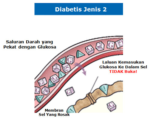 Diabetes type 2